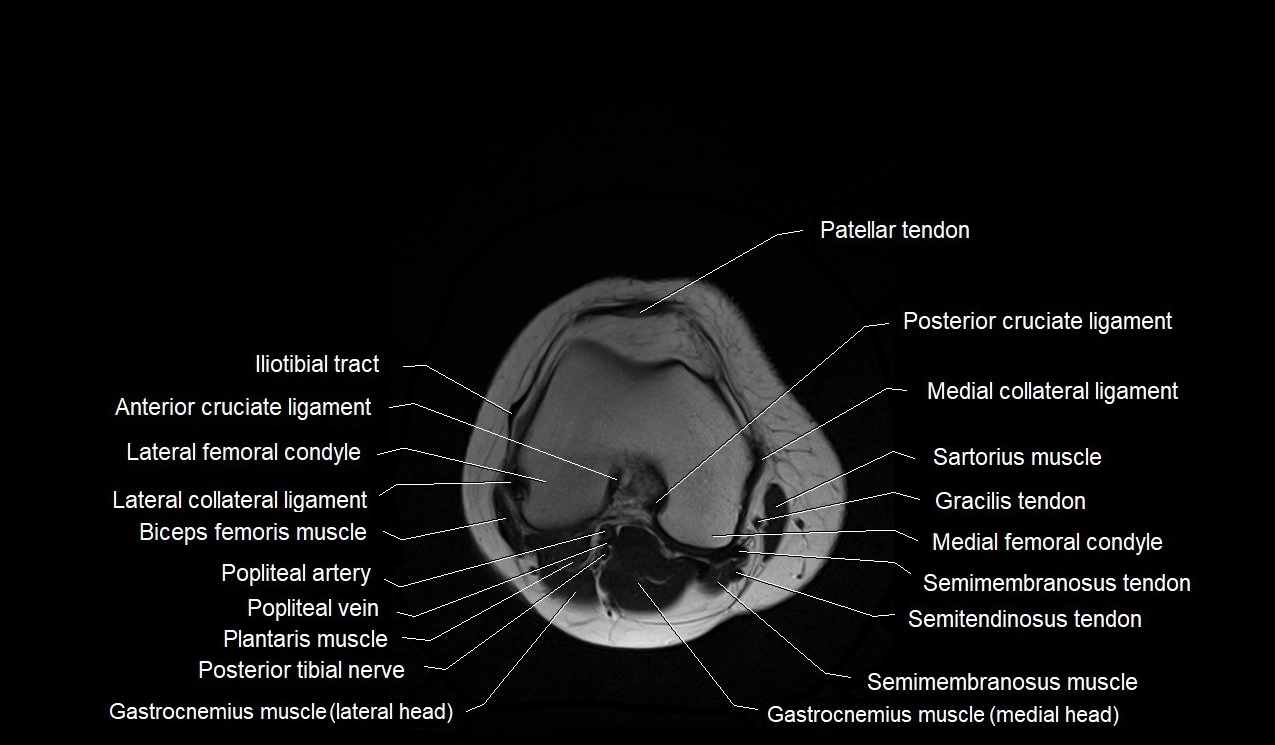 MRI thigh cross sectional anatomy image 57.webp